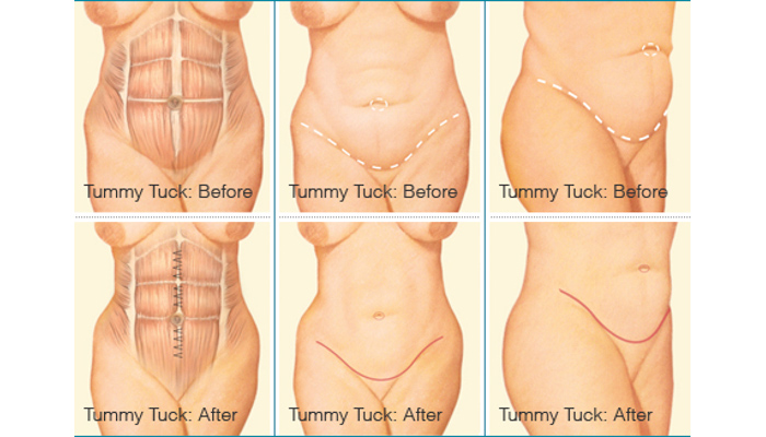 What is the difference between a panniculectomy and a tummy tuck?